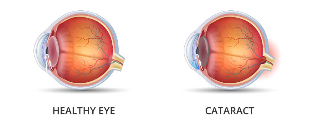 Healthy left eye and cataract on the right eye. The gradual clouding of the lens can significantly complicate your daily life and gradually steal your sight.