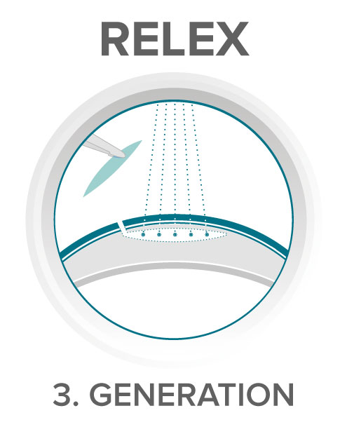 Relex Smile 3D femtosecond laser