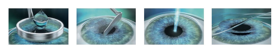 the course of eye surgery using the PRK method