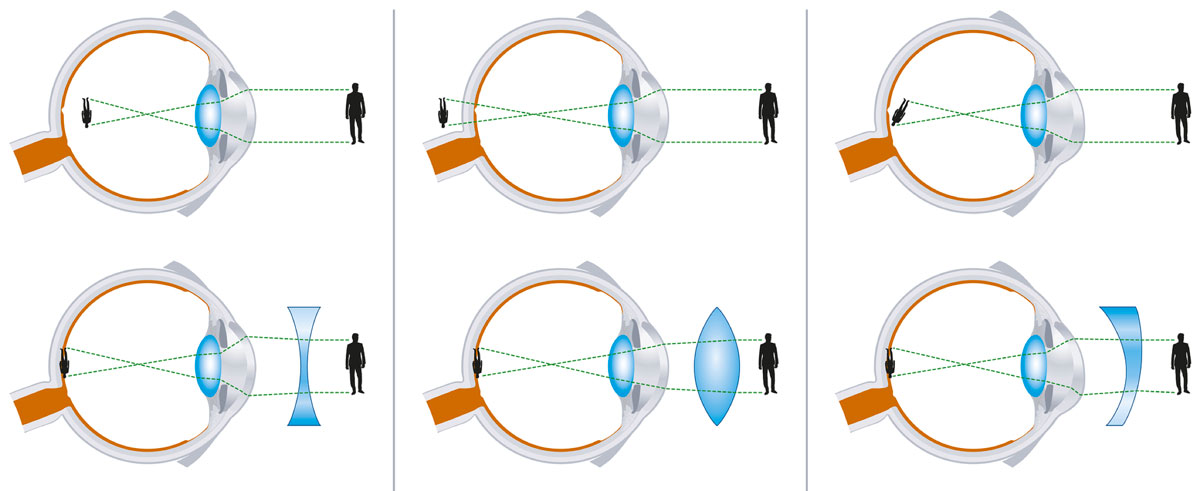 The difference between nearsightedness (myopia), farsightedness (hyperopia) and astigmatism