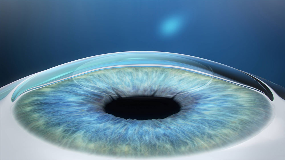 What can you expect from a Relex Smile eye surgery?