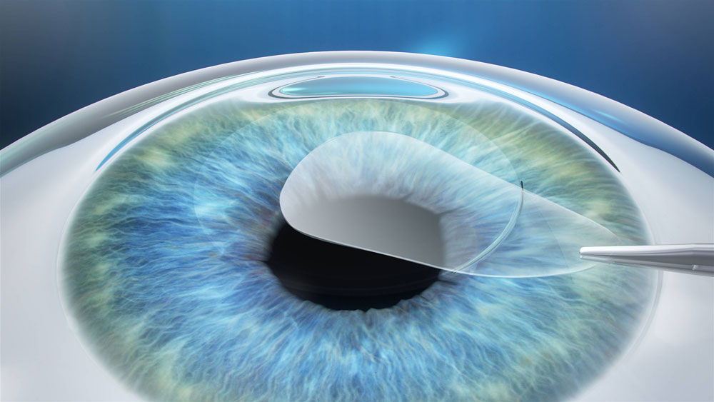 What can you expect from a Relex Smile eye surgery? 