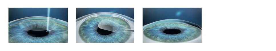 What is the procedure of the surgery? What is the procedure of the surgery?