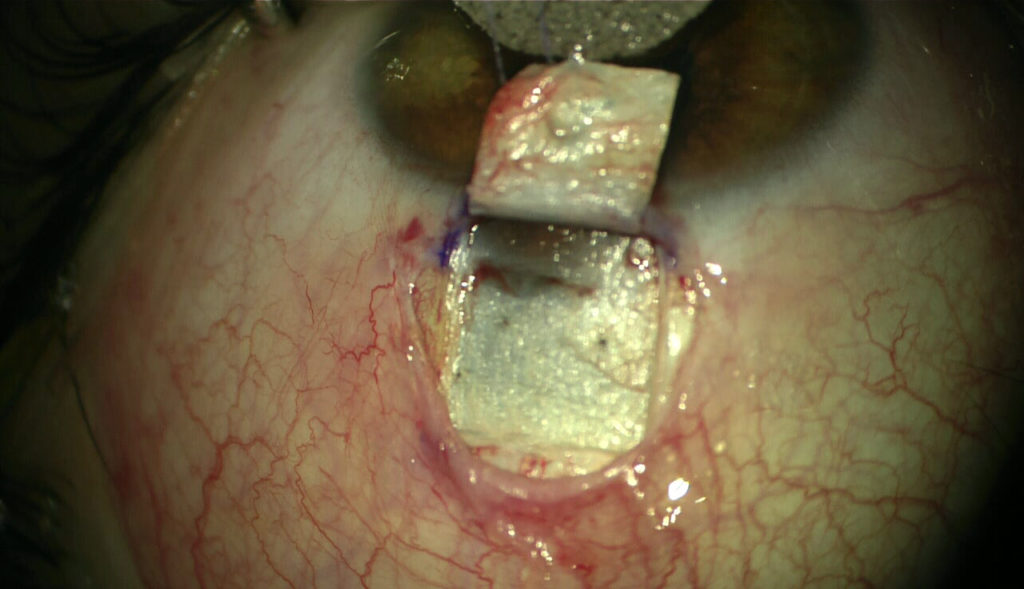 Peritomy and superficial scleral flap dissection extending to the clear cornea