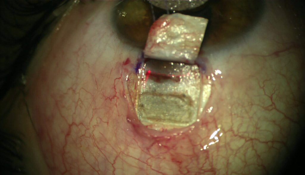 Laser ablation aimed at Schlemm’s canal