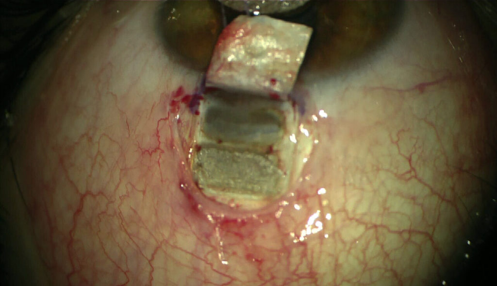Red aiming beam indicate and confine laser ablation zone distal to the limbus