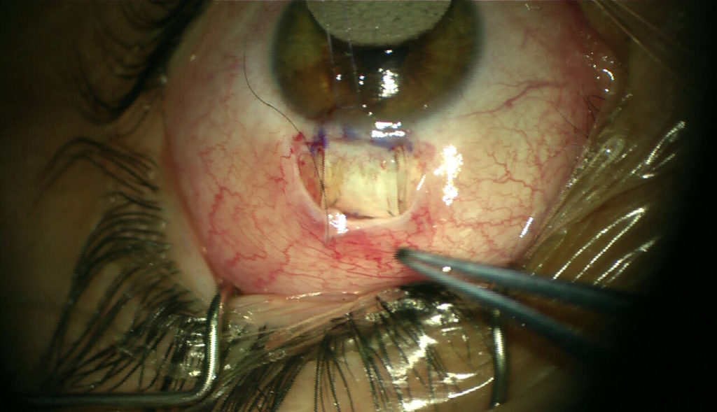 Scleral flap and conjunctiva suturing