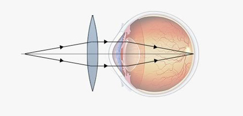 correction of Presbyopia