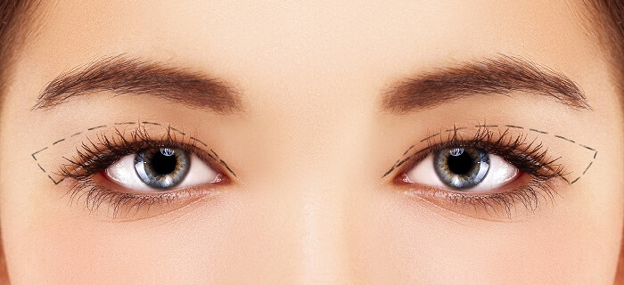 Plastic surgery of the upper eyelids