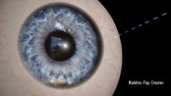 Z-Lasik - femtosecond laser