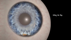 Z-Lasik - femtosecond laser