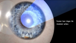 Z-Lasik - femtosecond laser