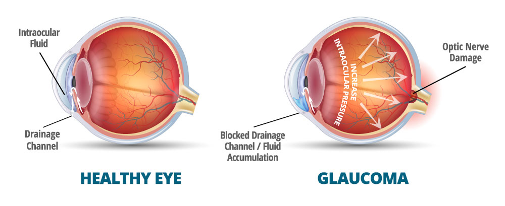 Glaucoma - green star